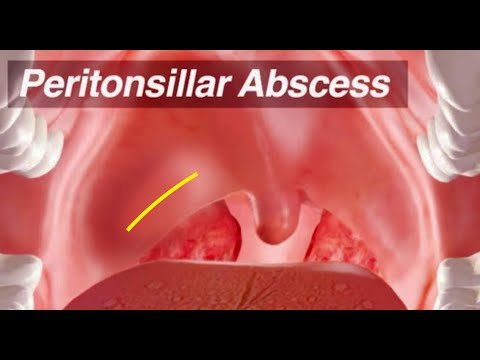 Peritonsillar Abscess - Identification and Treatment