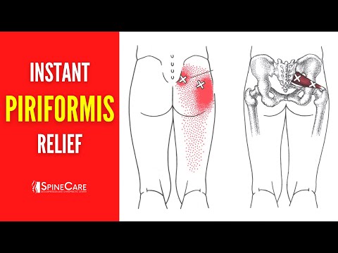 How to Get Rid of Piriformis Pain FOR GOOD