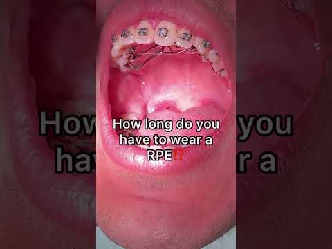 How long do you wear a RPE? Braces Checkups! Tooth Time Family Dentistry New Braunfels Texas